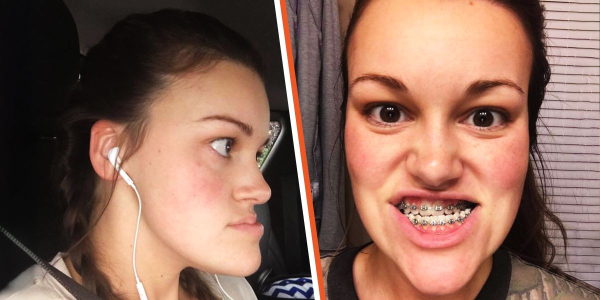This Young Woman, Who ‘Hated Looking in the Mirror,’ Underwent Double Jaw Surgery — Before & After Photos Stunned Everyone