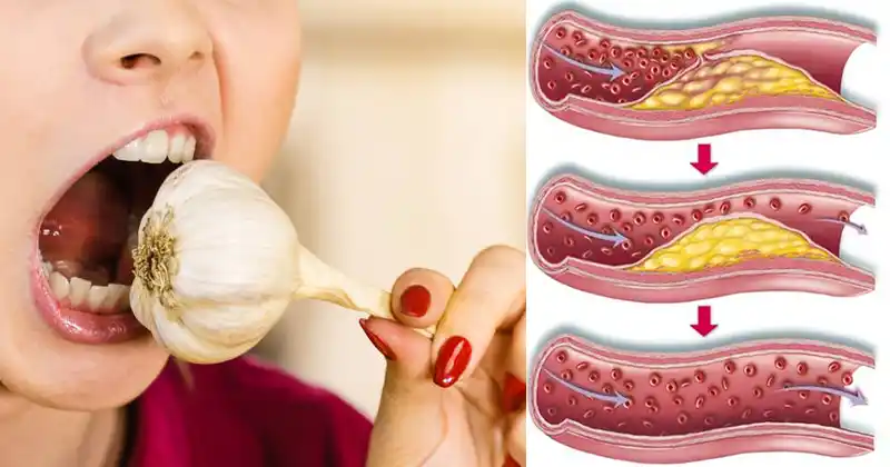 Eating Raw Garlic Daily: A Natural Way to Support Heart Health and Lower Cholesterol